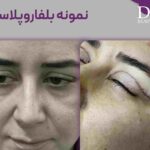 عکس نمونه بلفاروپلاستی