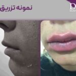 عکس تزریق ژل