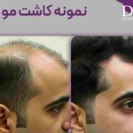 عکس نمونه کاشت مو