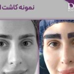 عکس کاشت ابرو